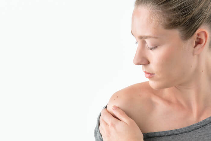 Concerned woman examining a mark on her shoulder.